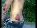 The Dudesons - Jukka lost skin