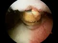my shoulder arthroscopy 2