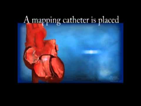 how to perform vt ablation