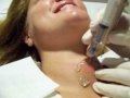 Fine Needle Biopsy of Thyroid Nodule Fine Needle Biopsy of Thyroid Nodule
