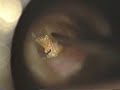 ear wax removal part 2