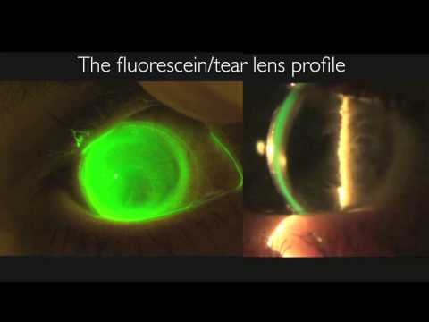 how to fit scleral lenses