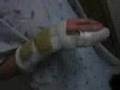 Wii Severed Nerve