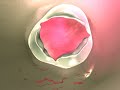Coronary Plaque Coronary Plaque