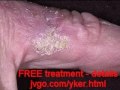 Actinic Keratosis Free Treatment at Home