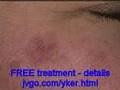 Actinic Keratosis Free Treatment at Home