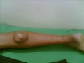 Dermoid cyst LOWER LIMB dr t varun raju