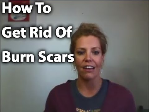 how to treat scars from a burn
