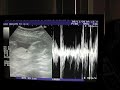 15 weeks 4 days ultrasound Boy or Girl?
