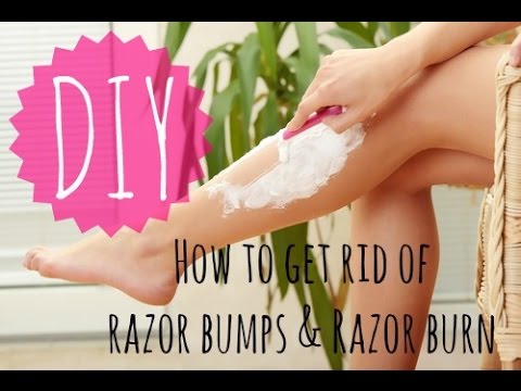 how to treat razor bumps