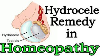 Hydrocele - Discussion and Treatment in Homeopathy