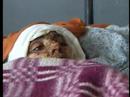 dec 2004
setting themselves on fire is the only perceived means of protest for many women in afghanistan. cases of self immolation are on the increase. 

idemah's body is covered in raw burns. she's so badly burnt that doctors are sure she will die. 