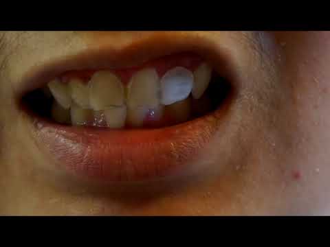 how to repair teeth
