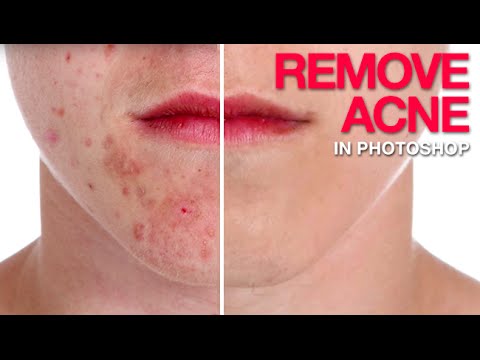 How to Remove Acne in Photoshop