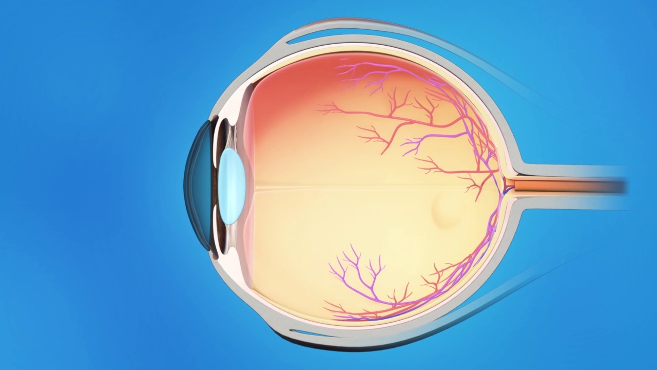 Understanding glaucoma