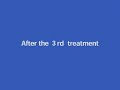 Outcomes of treatment for Parkinson's disease - Ex11(NEW)  Osteoarthritis Chiropractic
