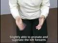 Outcomes of treatment for Parkinson's disease - Ex11(NEW)