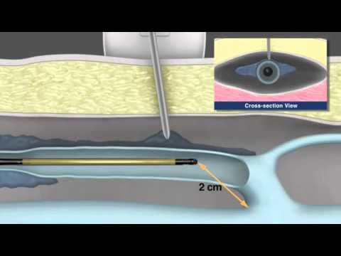 how to treat cvi