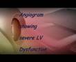 Spongy myocardium & Progressive cardiac failure
