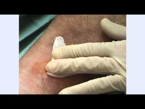 how to treat erysipelas
