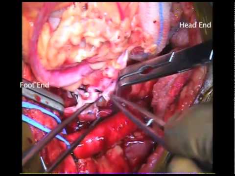 how to apply for kidney transplant