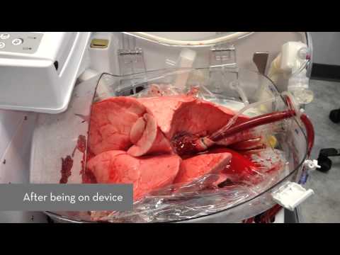 how to get a lung transplant