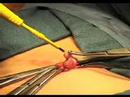 Appendectomy Operation Appendectomy Operation