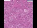 Histopathology Liver--Cirrhosis (micronodular)