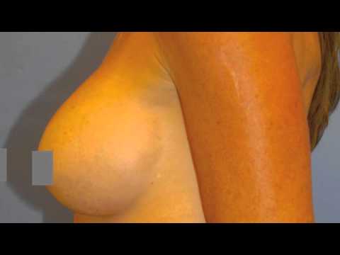 Pregnancy breast