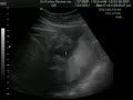 3tr Video de nuestra Niñita 3tr Video de nuestra Niñita