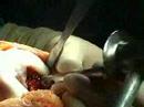 Mosaicplasty of the Knee