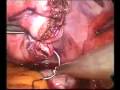 laparoscopic myomectomy using the Roder\