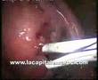 laparoscopic myomectomy using the Roder's knots