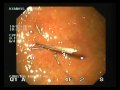 Gastrostomy Tube In Low Profile Type Gastrostomy Tube In Low Profile Type