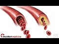 Insidermedicine in 60 - April 9, 2008 Vaccines and Diabetes
