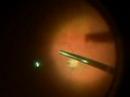 Macular Hole Vitrectomy Gas Macular Hole