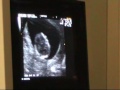 Ultrasound Scan Sarah & Darren Valentine Baby