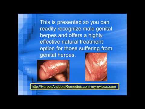 how to cure outbreaks of herpes