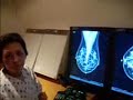 prevencion cancer de seno