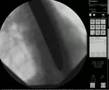 videos de Sword swallowing X Ray - Dai Andrews - 90 degree  curve