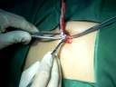 Transumbilical Conventional Appendectomy by Sidho Hantoko, MD, FInaCS