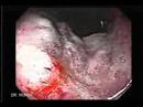 Video Clip an Endoscopy of a Stomach Cancer