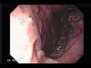 Video Clip an Endoscopy of a Stomach Cancer