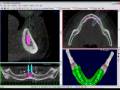 videos de Bioparts - Tutorial 8 DentalSlice: Ad. Implantes Parte2 de 2