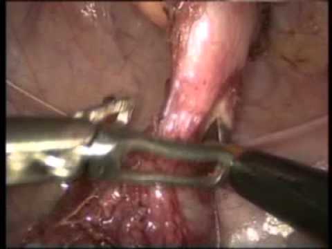 how to treat omphalitis