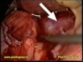 Adenoma del surrene asportazione del surrene