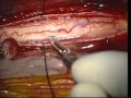 Complete Removal Of Ependymoma Of Thoracic And Cervical Part Of The Spinal Cord Complete Removal Of Ependymoma Of Thoracic And Cervical Part Of The Spinal Cord