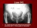 developmental dysplasia of the hip the modified hoffmann daimler method.wmv