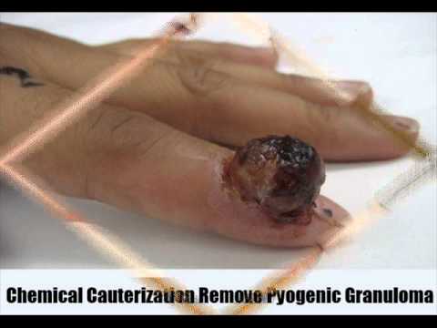 how to cure umbilical granuloma