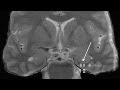 Parkinson's Research Yields Progress on Memory Treatment